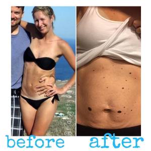 before and after belly